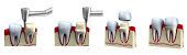 Prepping a tooth for a crown
