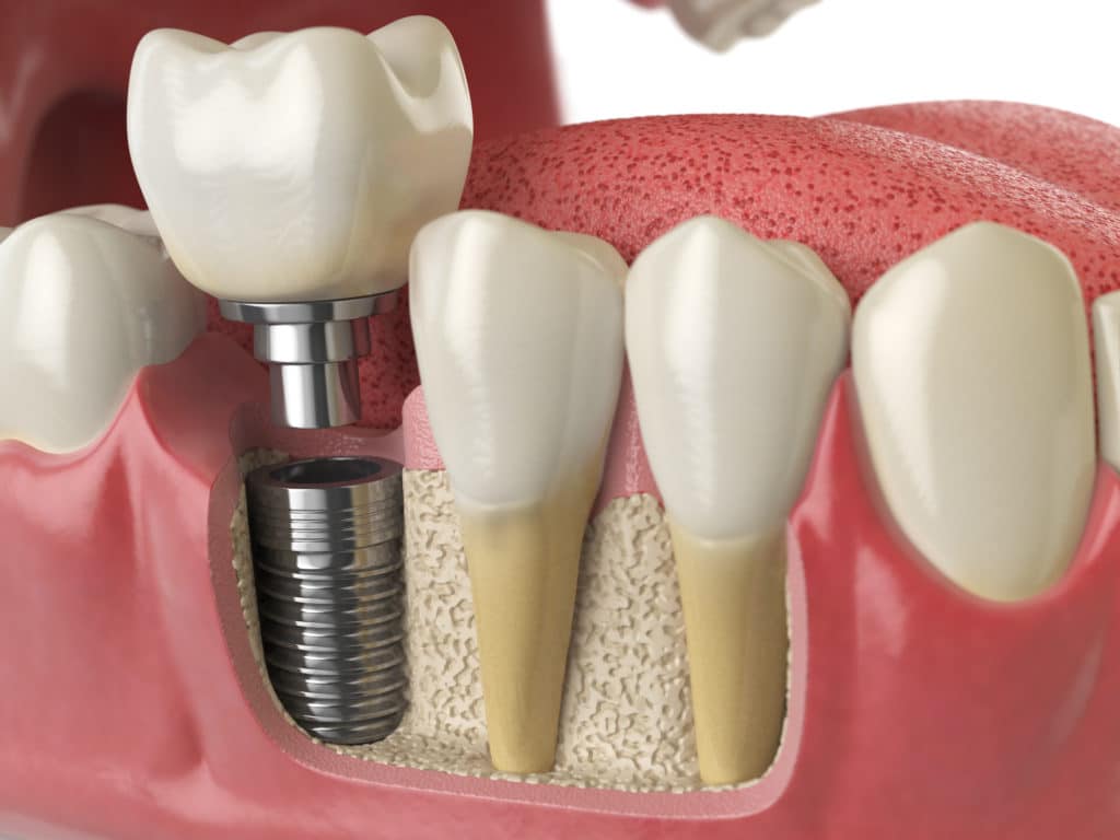 Dental implant vs. tooth and root