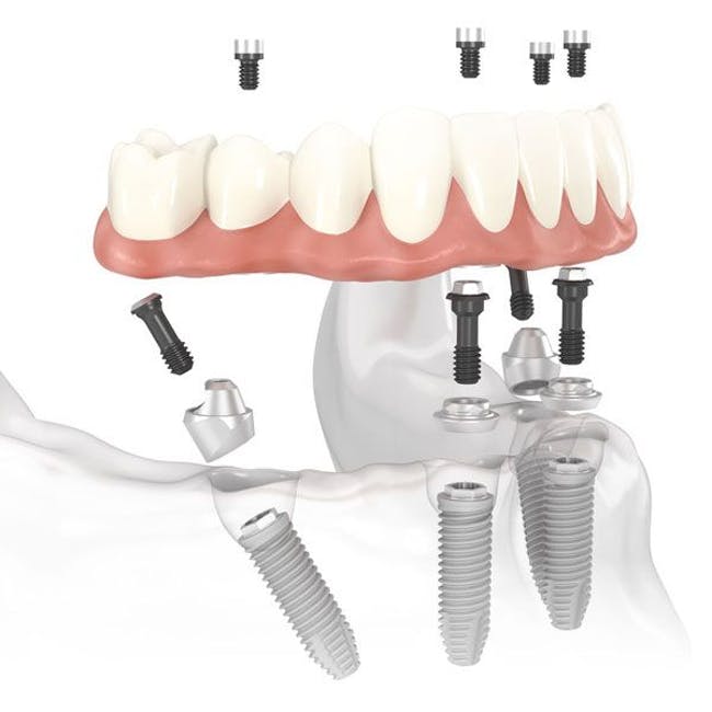 illustaration of all on 4 dental implants