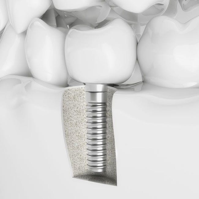 Illustration of dental implants