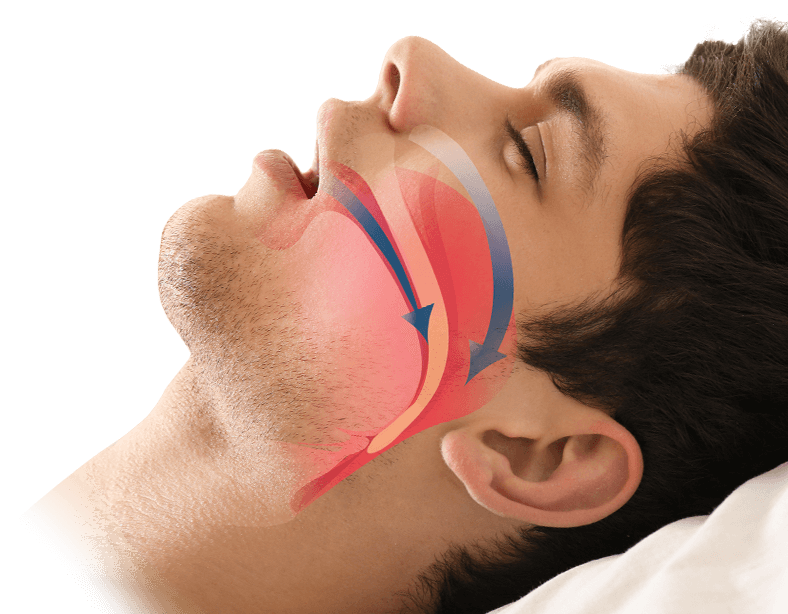 Man asleep with mouth open