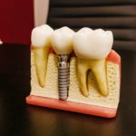 Dental Implants mold