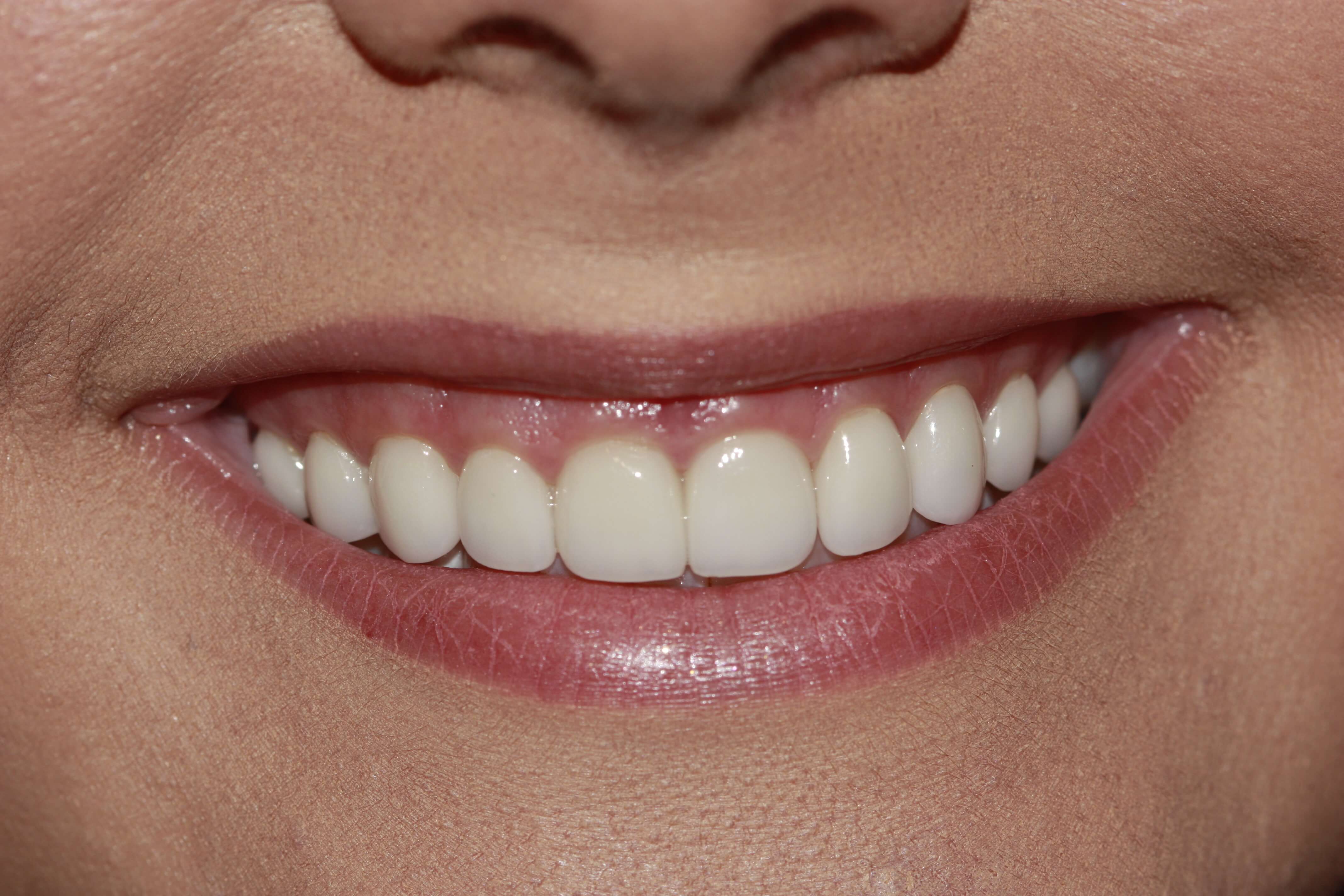 AFTER picture cosmetic dentistry