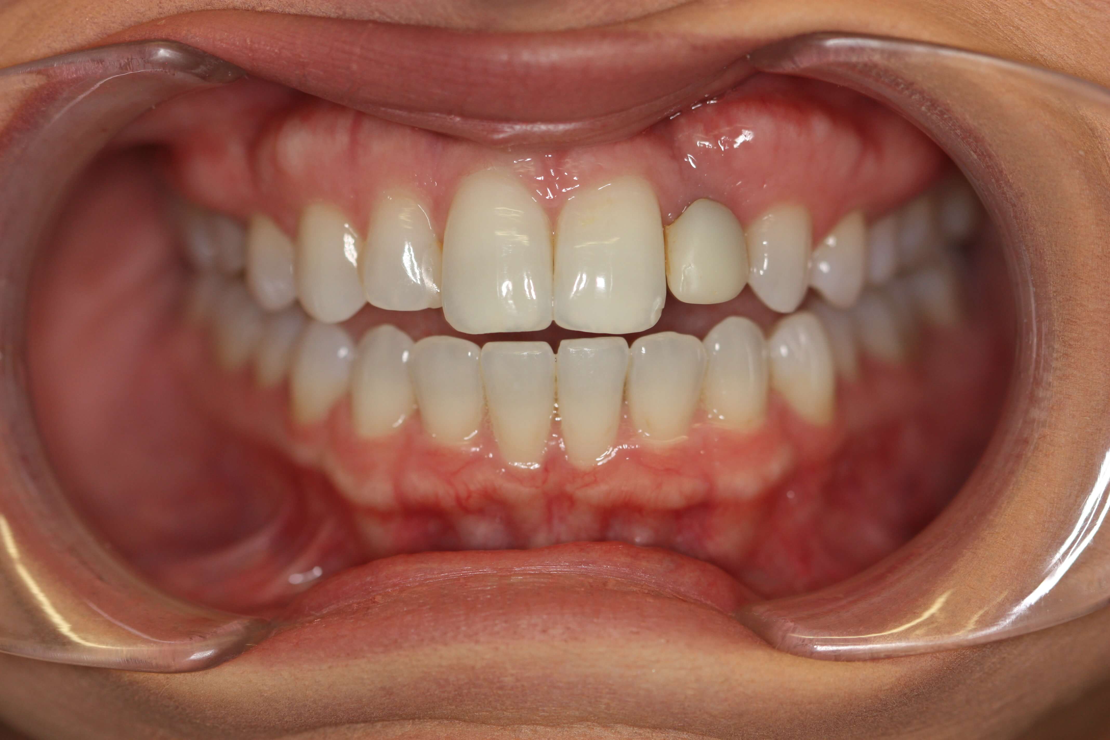 Before Picture of a smile makeover with Veneers