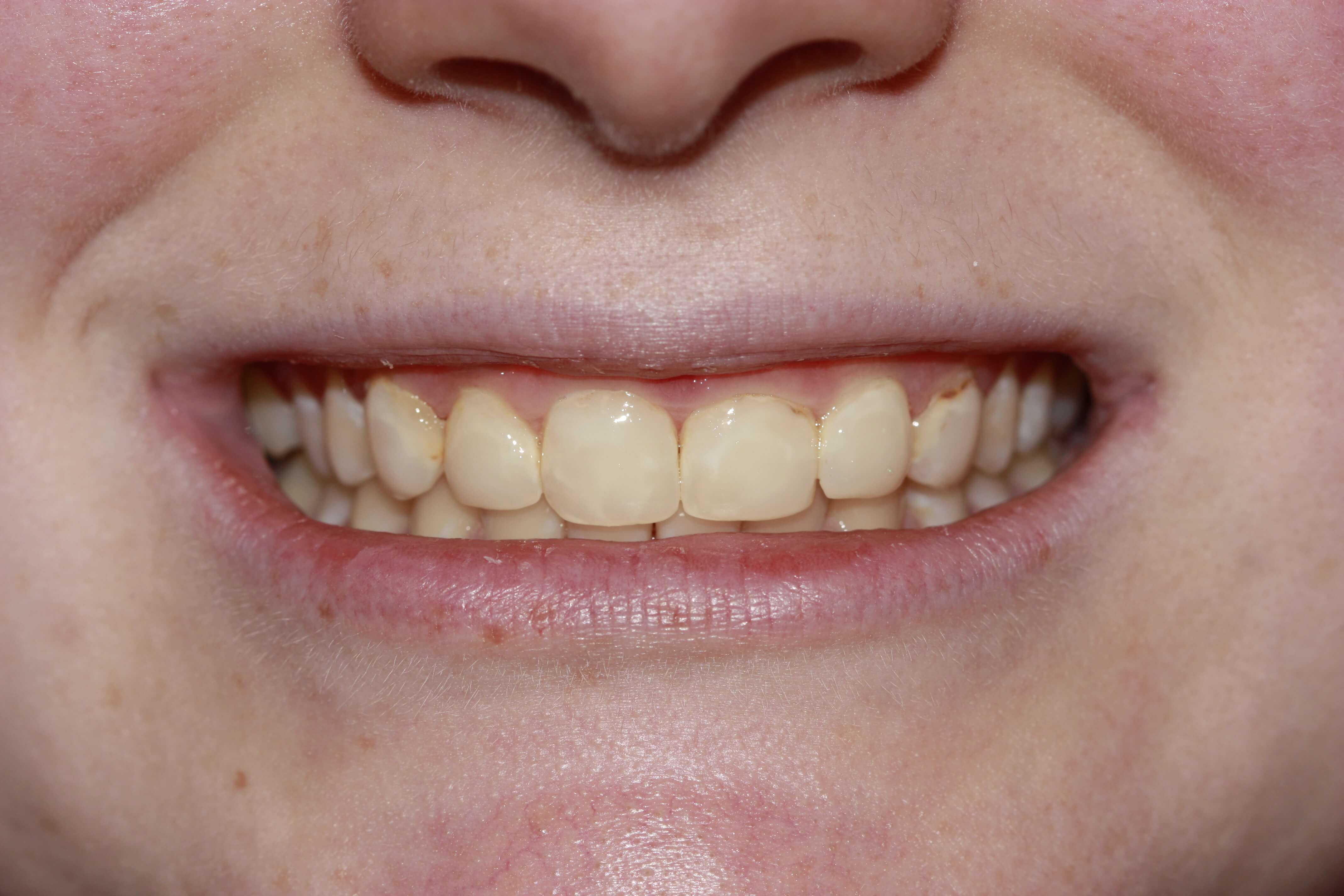 Before picture of a smile makeover with veneers