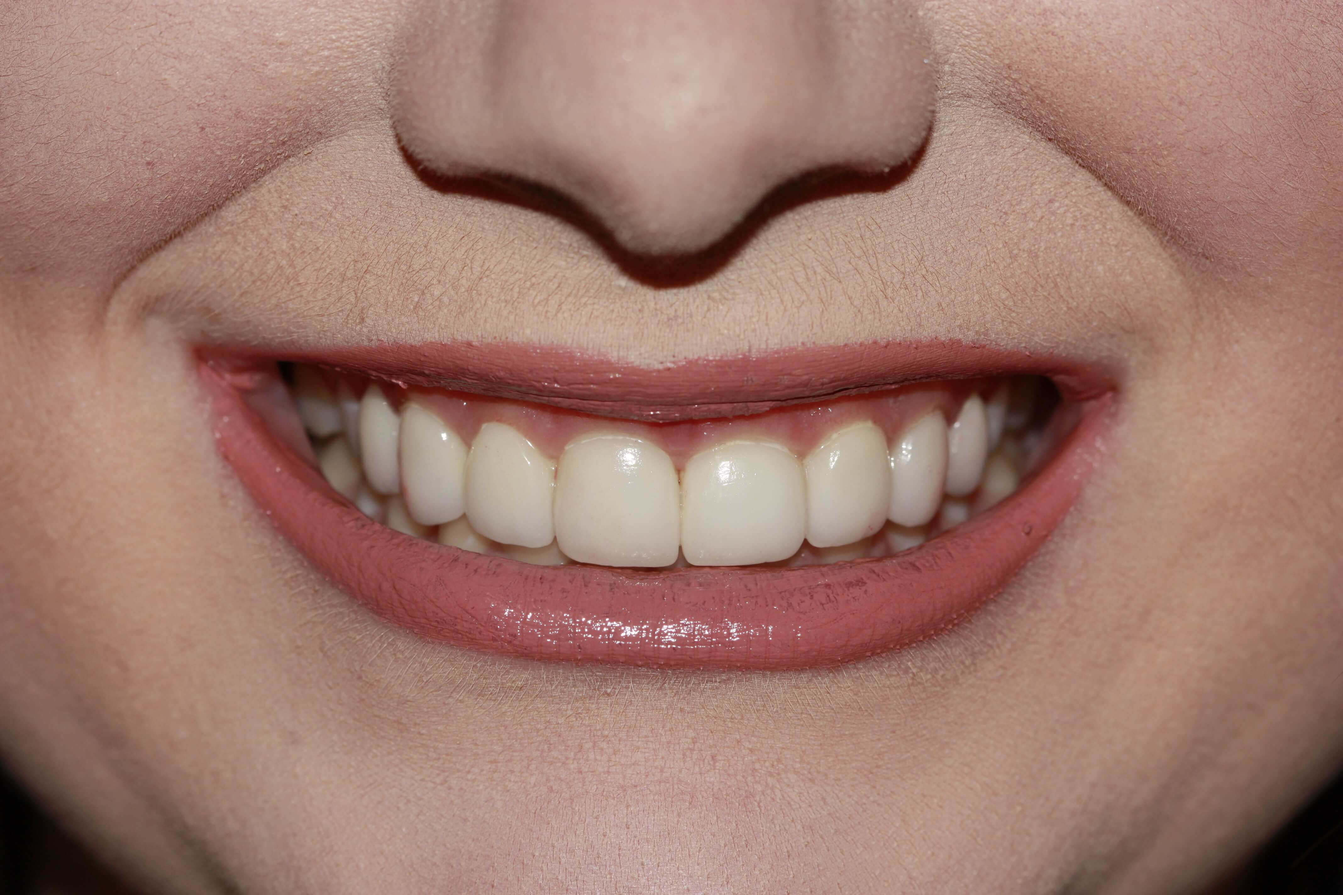 After picture of a smile makeover