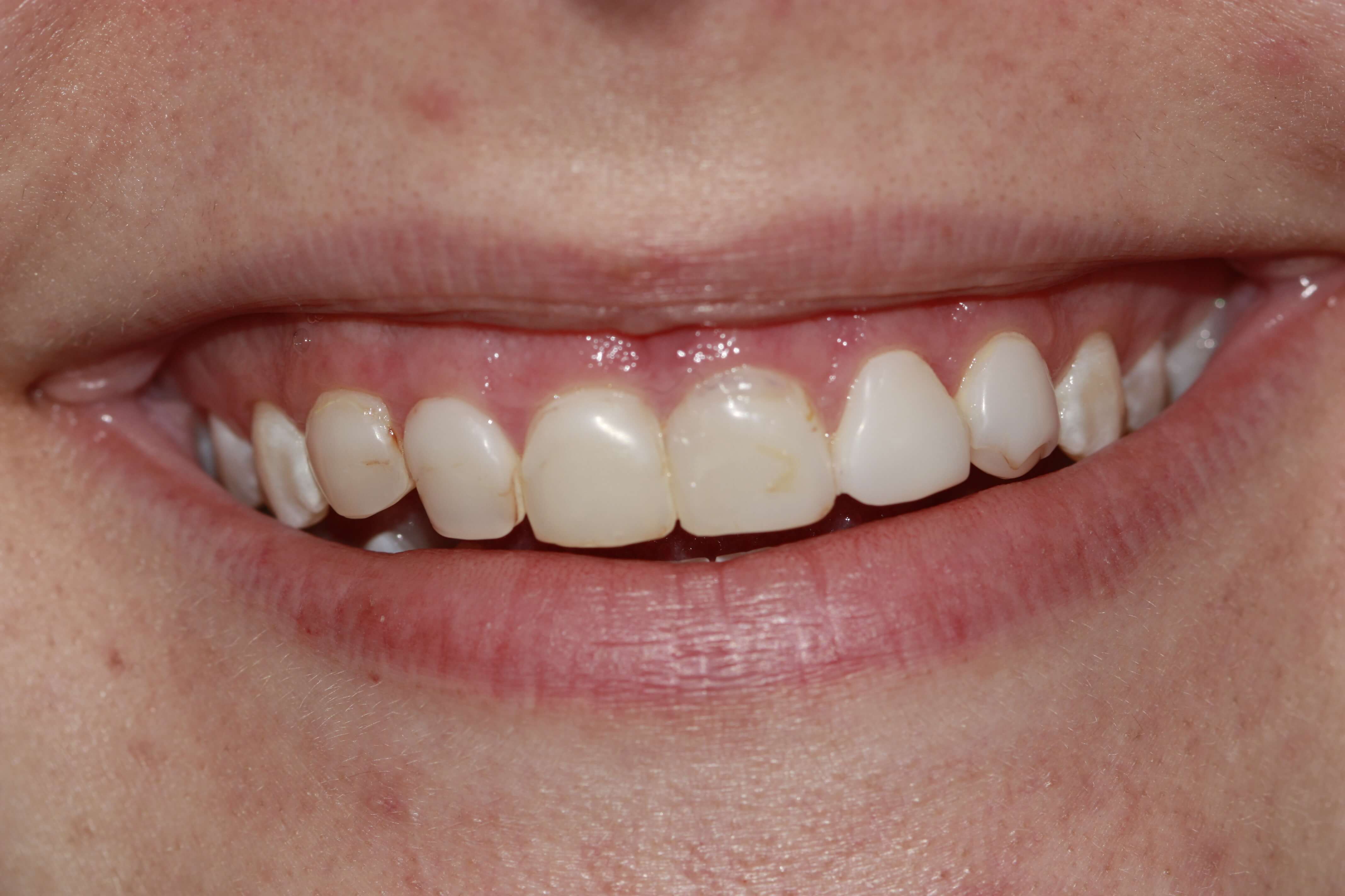 Before cosmetic dentistry patient