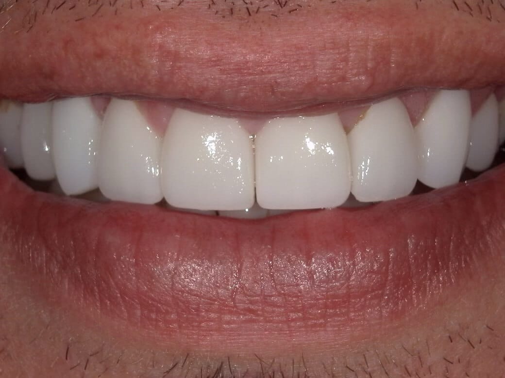 After photo of a smile makeover