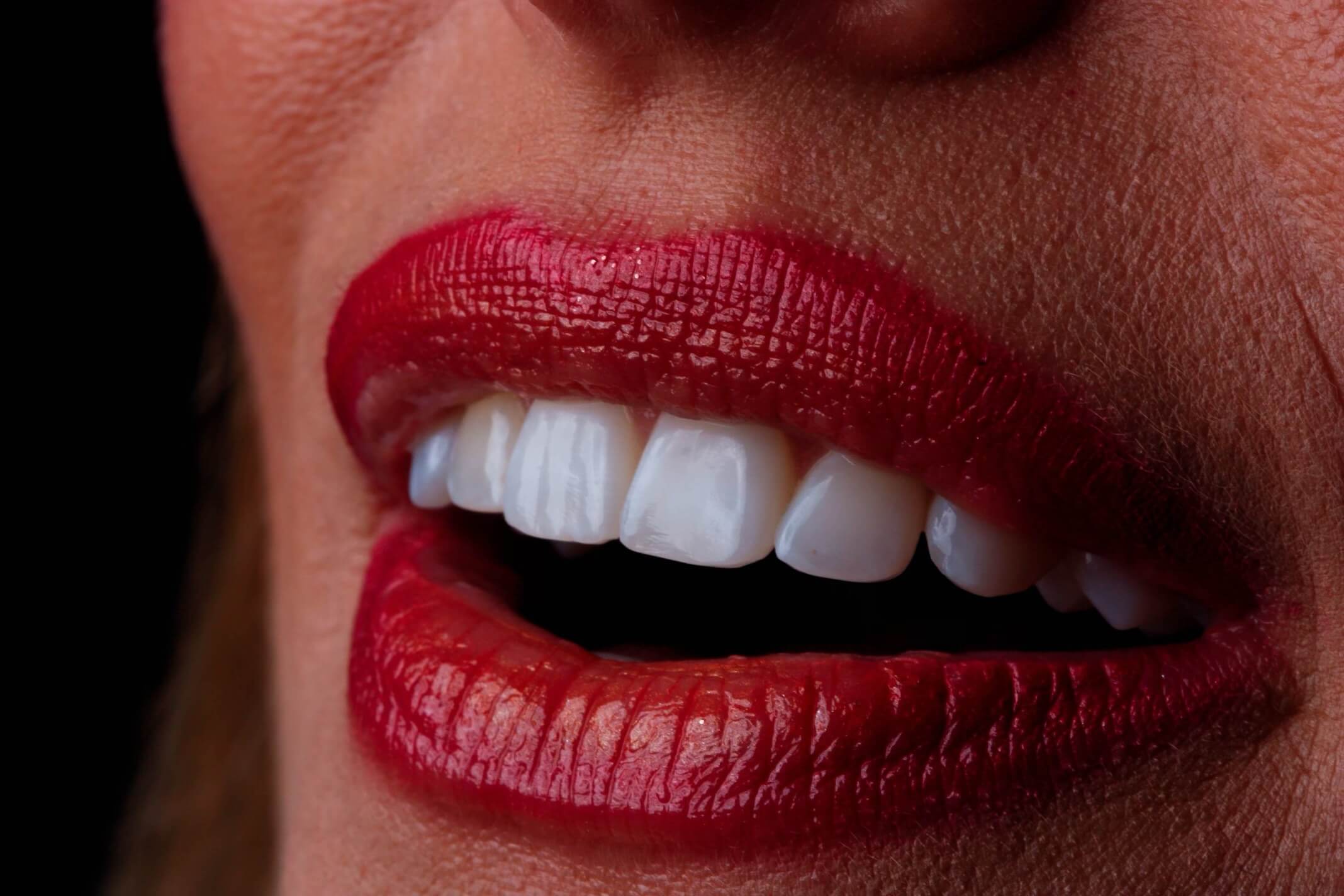 women with red lips and veneers