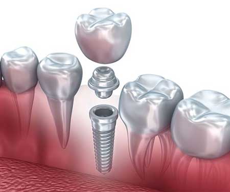 Dental Implants illustration