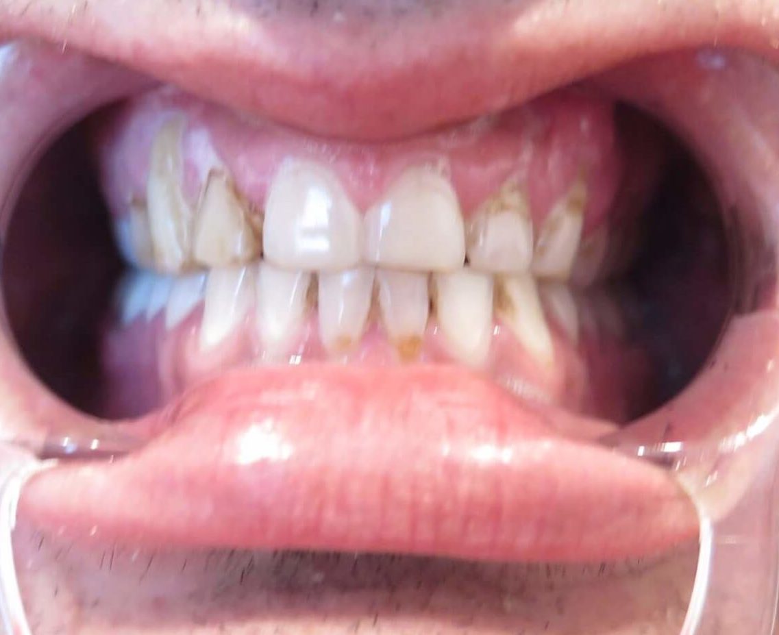 Before picture of a smile makeover