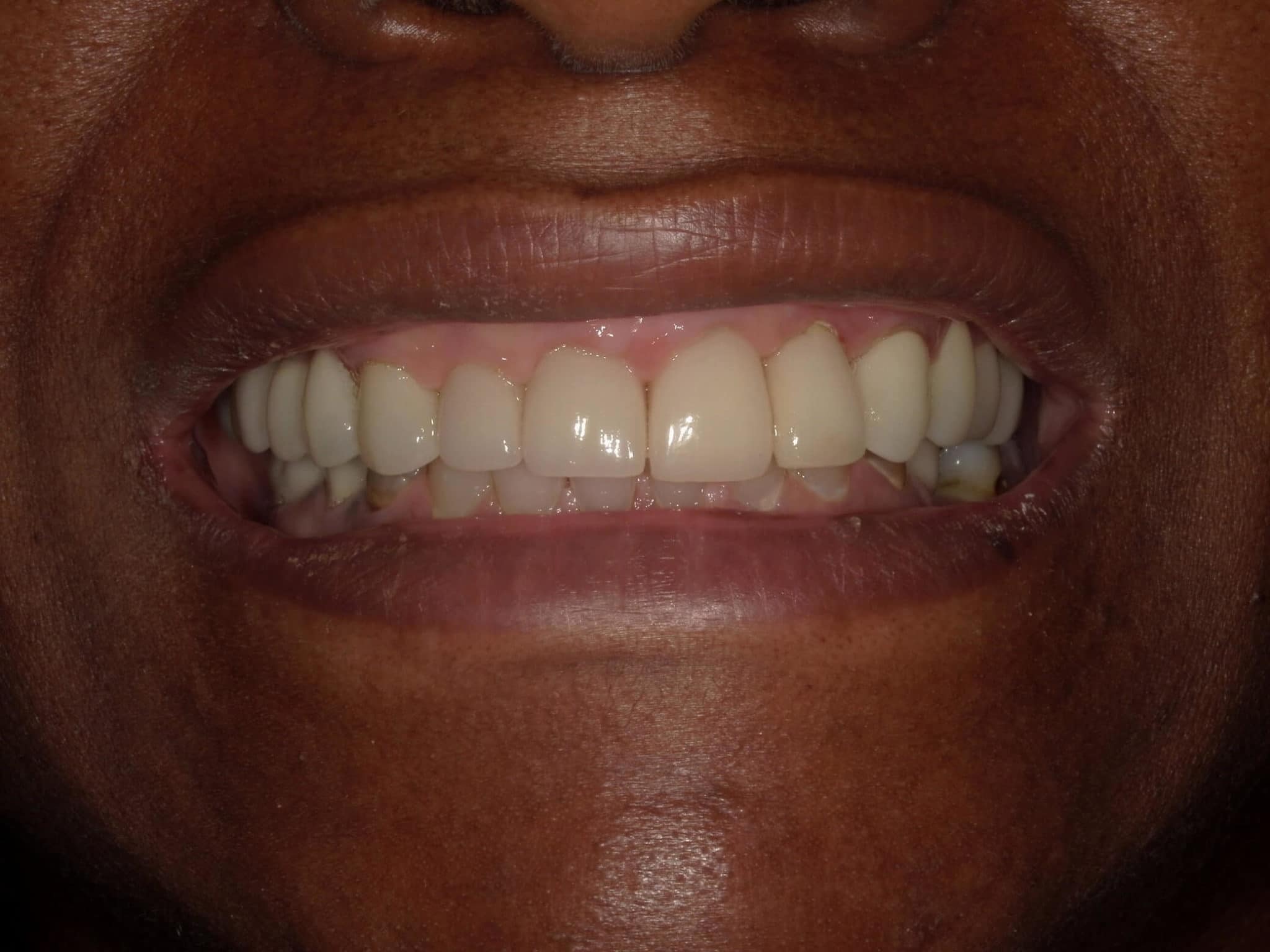 After picture of a patient from Oxford, MS with a smile makeover