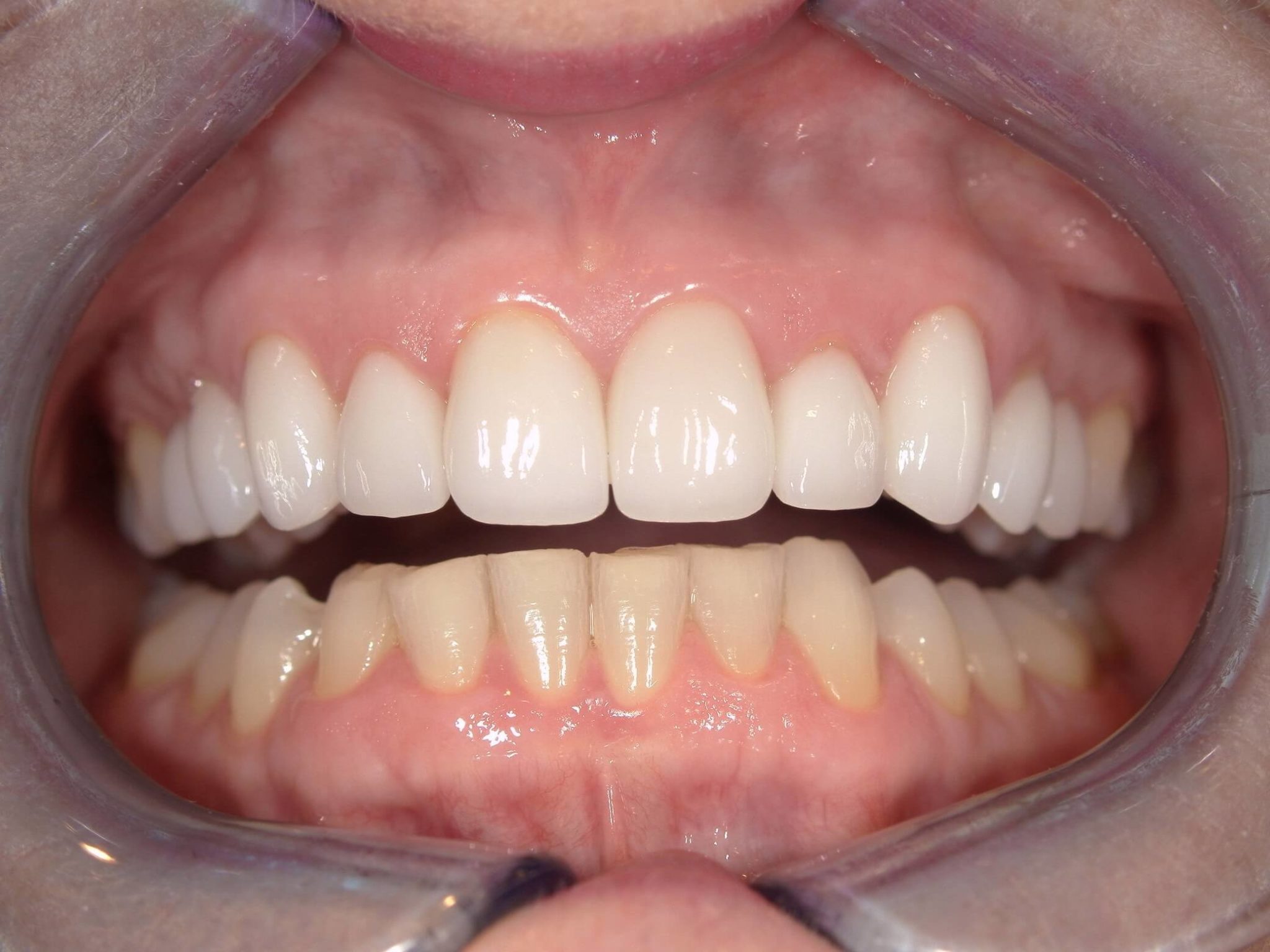 After picture of Veneers patient from Oxford, MS