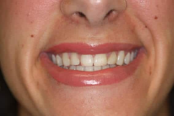 Patient smiling with veneers