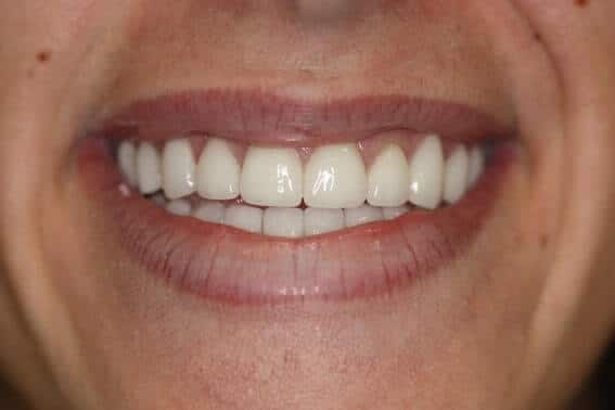 After photo of patient with Veneers