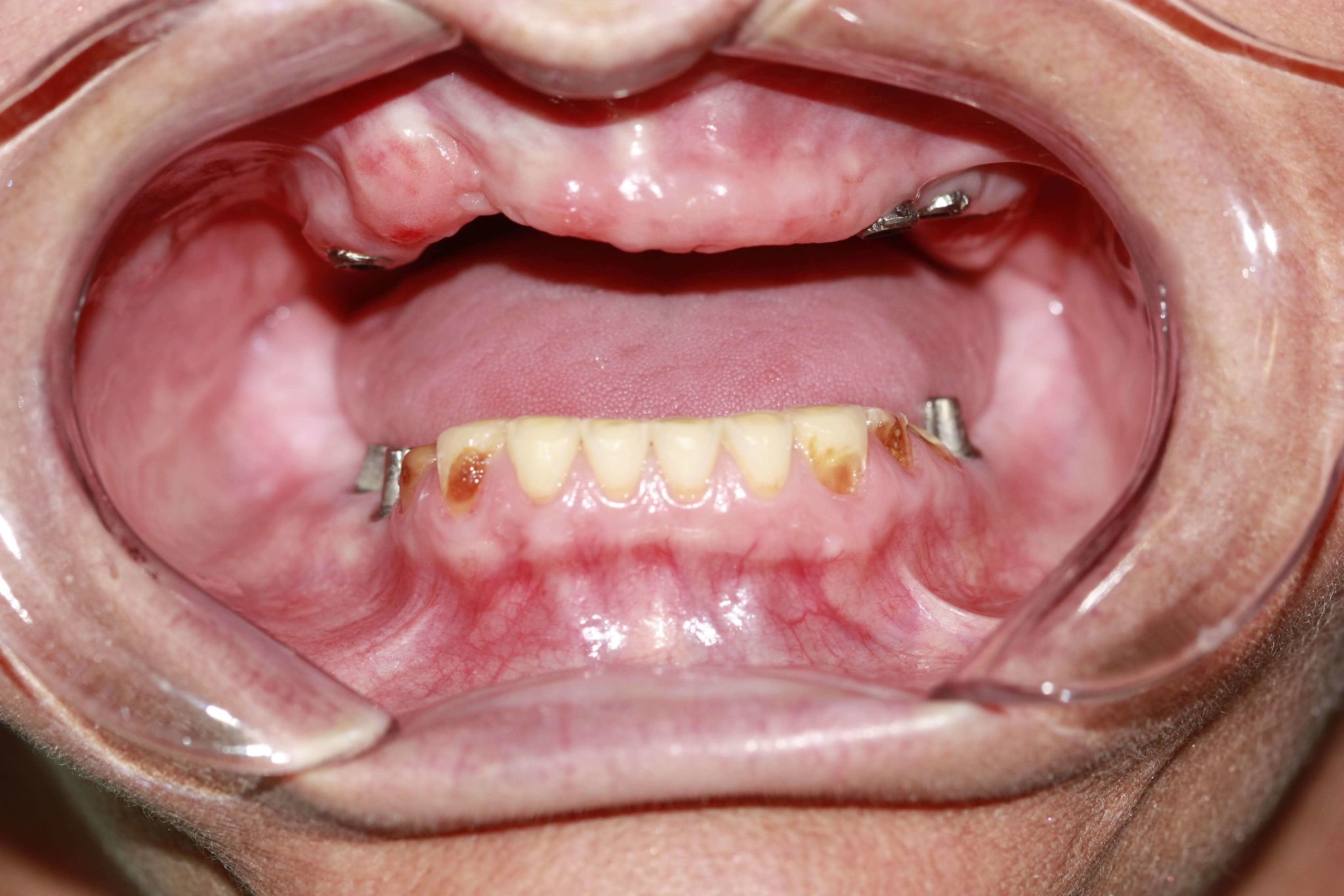 Before picture of All-On-4 dental Implants