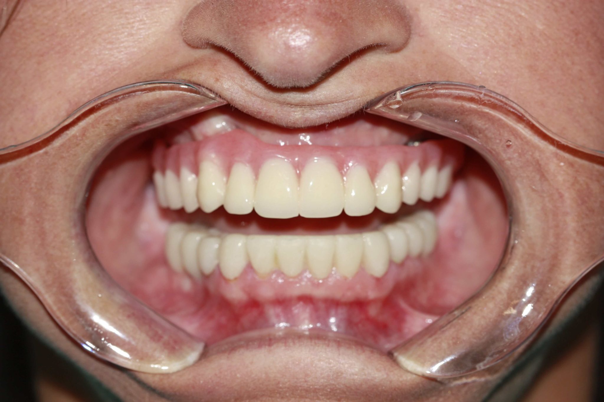 After picture of a patient after All-On-4 dental implants