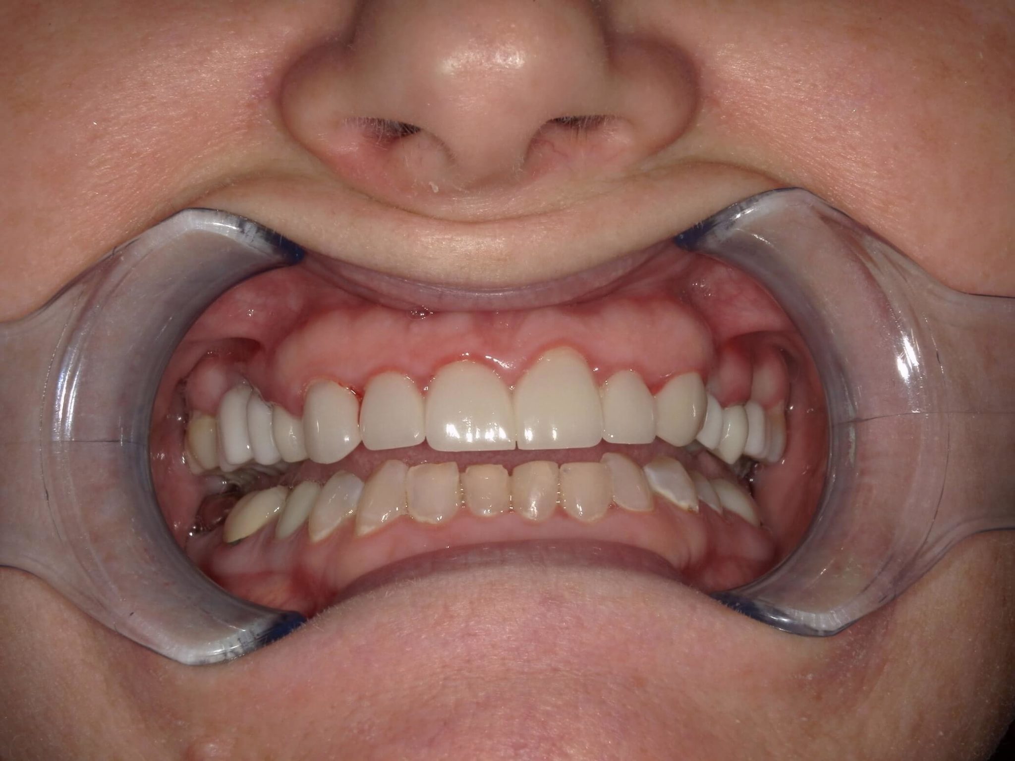 After picture of a patient who received veneers