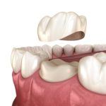 Dental crown being placed on top of tooth