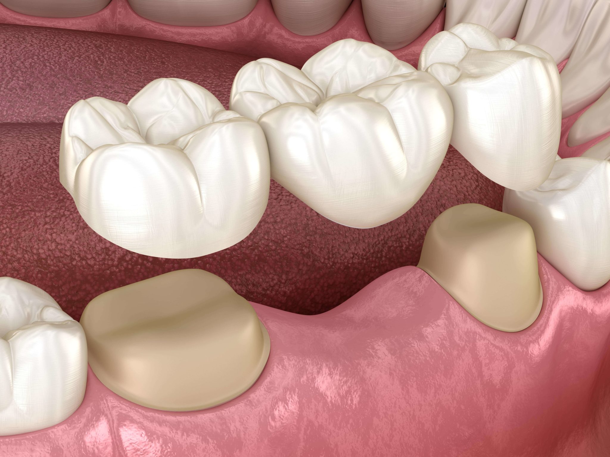 Dental bridges illustration