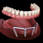 Implant supported denture illustration