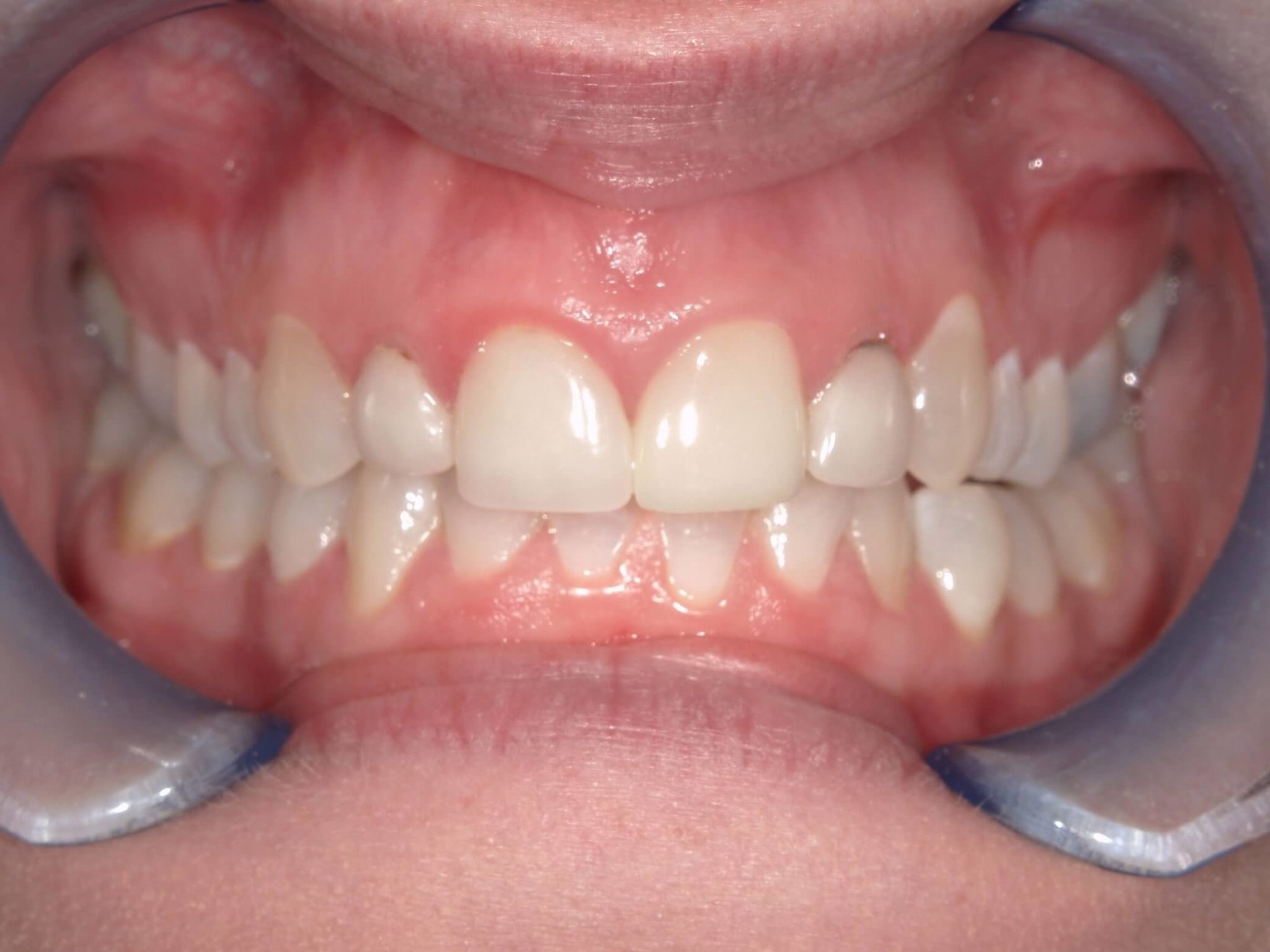 After picture of dental crowns