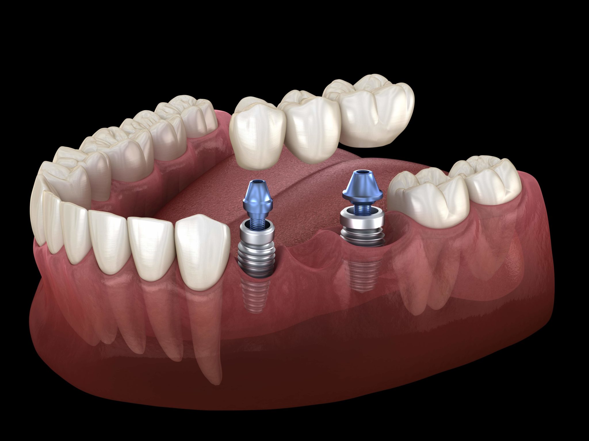 Implant-Supported Bridges illustration