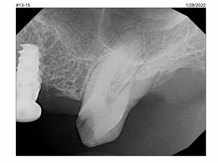 Bone Graft After