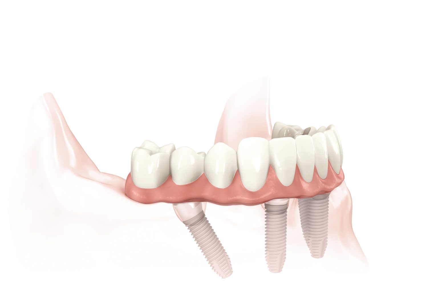 SAME DAY TEETH® Greenwood, MS - Oxford, MS - Dr. Todd Fincher DDS,