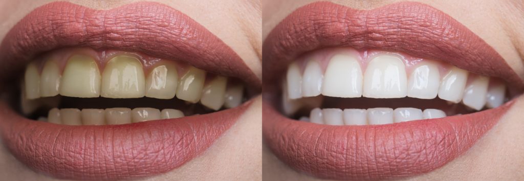 Before and after teeth whitening