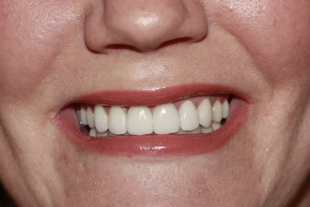 After picture of a patient who received veneers